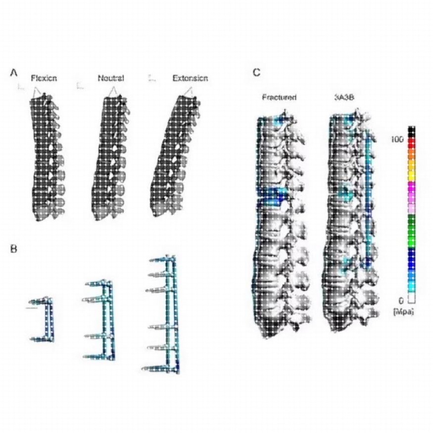 医学有限元分析 生物力学彷真模拟 Ansys Workbench有限元分析.