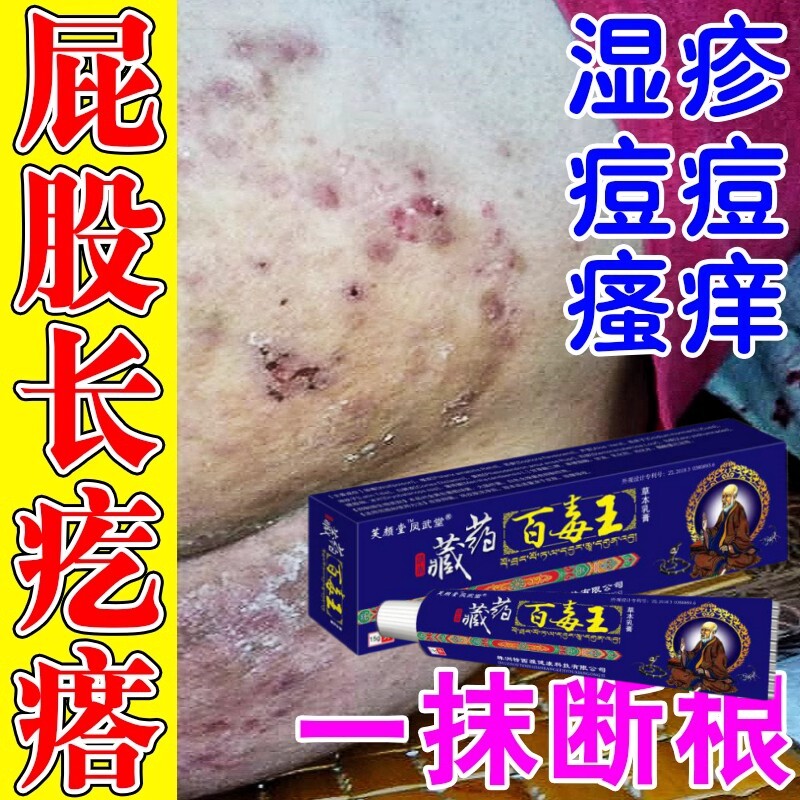 治大人屁股上长痘痘痒起热疙瘩藓久坐拔毒膏红瘙痒坐板疮皮肤的药
