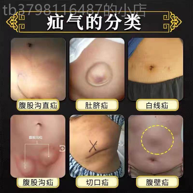 极速疝气贴成人儿童小肠腹股沟中老年脐疝手术防复发专用疝气治