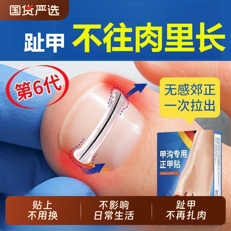 甲沟矫正器正甲贴片嵌甲贴片脚趾指甲专用工具指甲刀趾甲炎钛合金