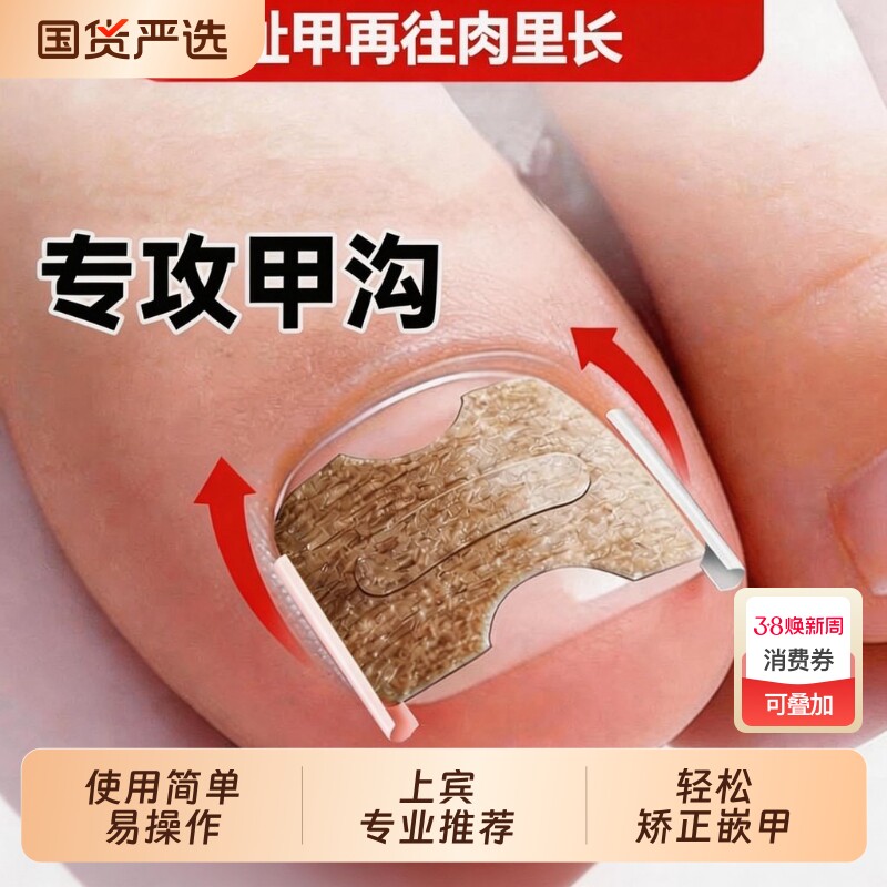 甲沟矫正器脚指甲往肉里长专用正甲贴片嵌甲矫正趾甲扎肉纠正工具