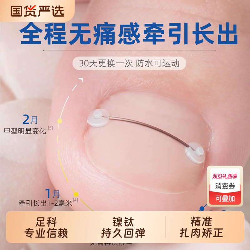 脚趾甲沟嵌甲矫正器合金牵引弹丝正甲器正甲贴片炎脚指甲扎肉神器