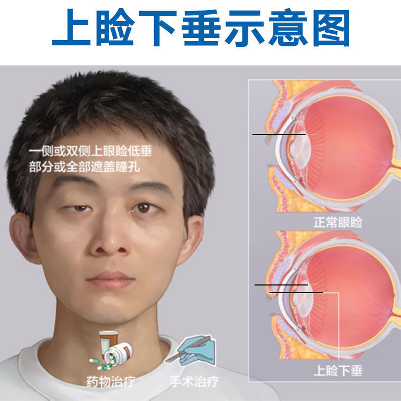 好货上眼皮眼角下垂提拉贴眼睑松弛肿眼泡去肿提拉紧致双眼皮专用