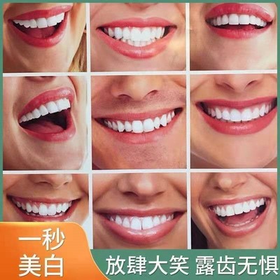 速发门牙贴片遮盖缺牙临时牙套牙贴面瓷贴面遮丑美白全瓷假牙套牙