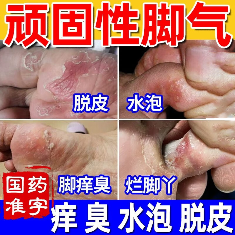 九芝堂足光散正品香港脚泡脚药包脚气脱皮杀菌止痒足癣脚癣止痒药 OTC药品/国际医药 癣症 原图主图