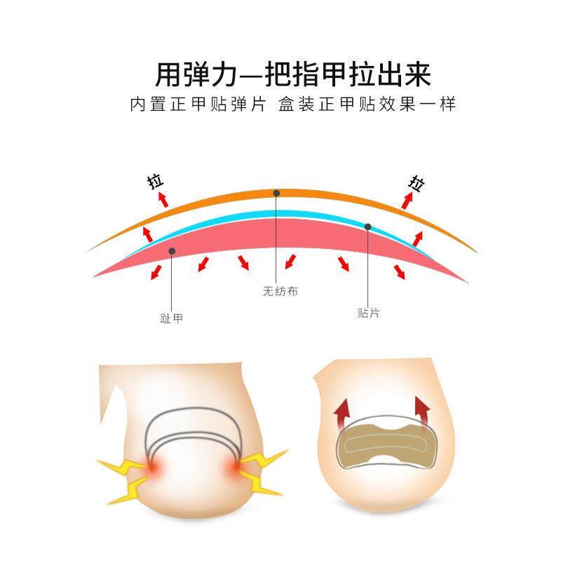 速发免正甲贴脚趾甲甲沟嵌甲矫正器脚趾甲贴片拉拉修指甲