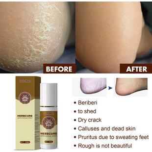 Anti Spray Antibacterial Exfoliati SwLeat Odor Itch 极速Foot