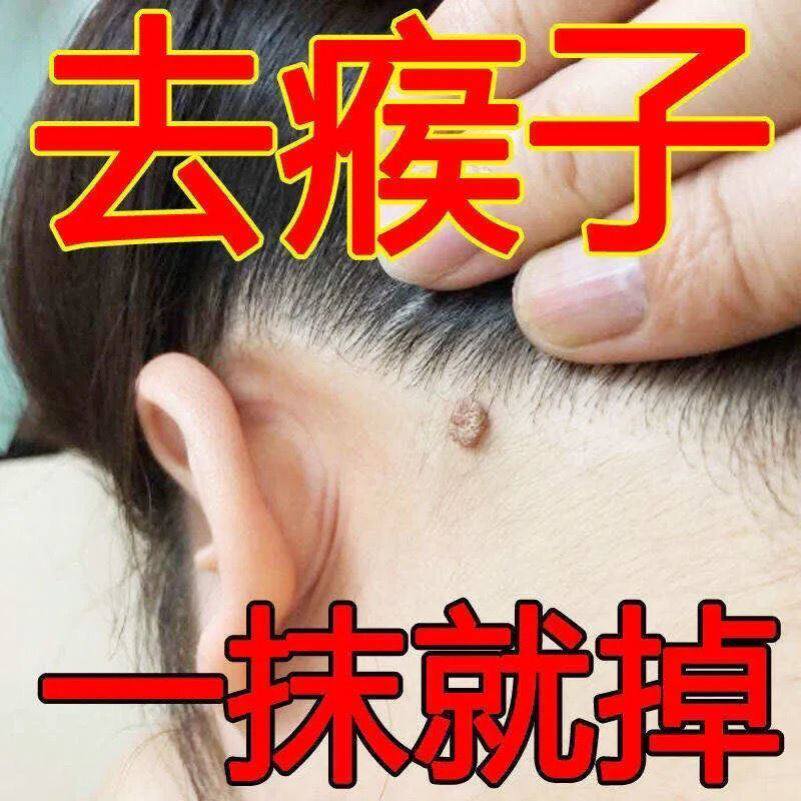 极速克尤王鸡忧优独猴康灵官网z清疣灵软膏清尤刺猴茧灵马玛码锋