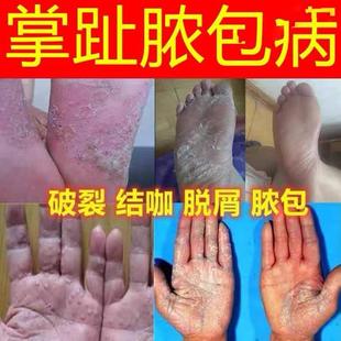 极速掌跖a角化症掌趾脓包病手脚蜕皮干裂红斑角皮症掌跖脓疱病外