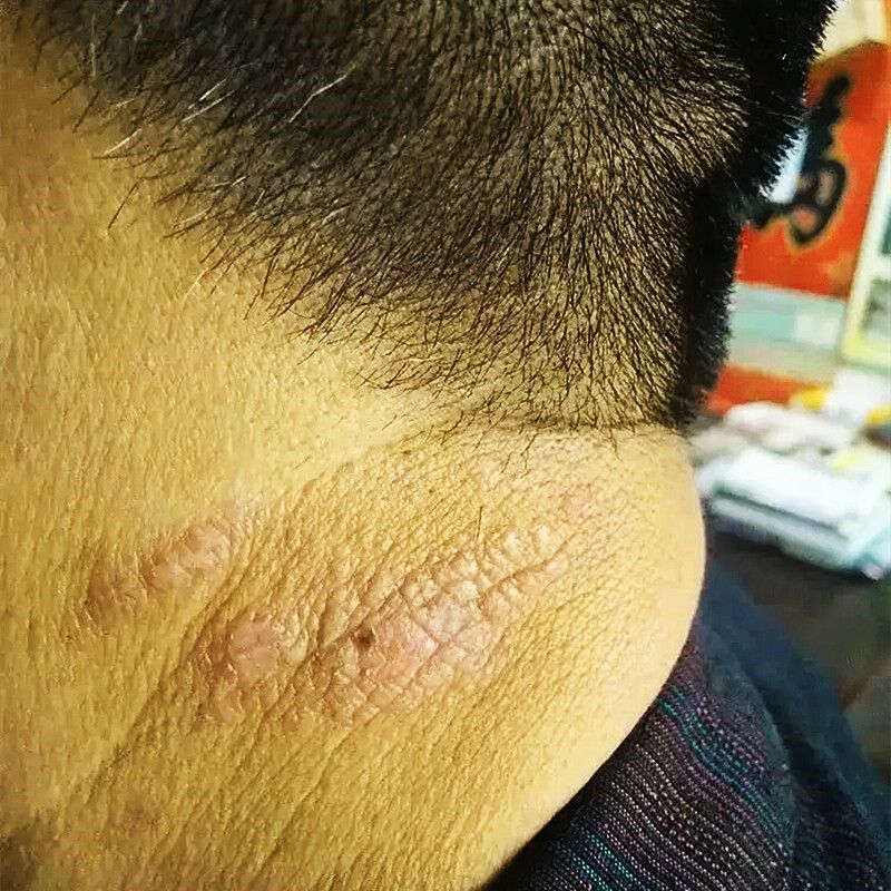 神经性皮炎脖子上长癣瘙痒脖子红痒刺挠过敏脖子疙瘩