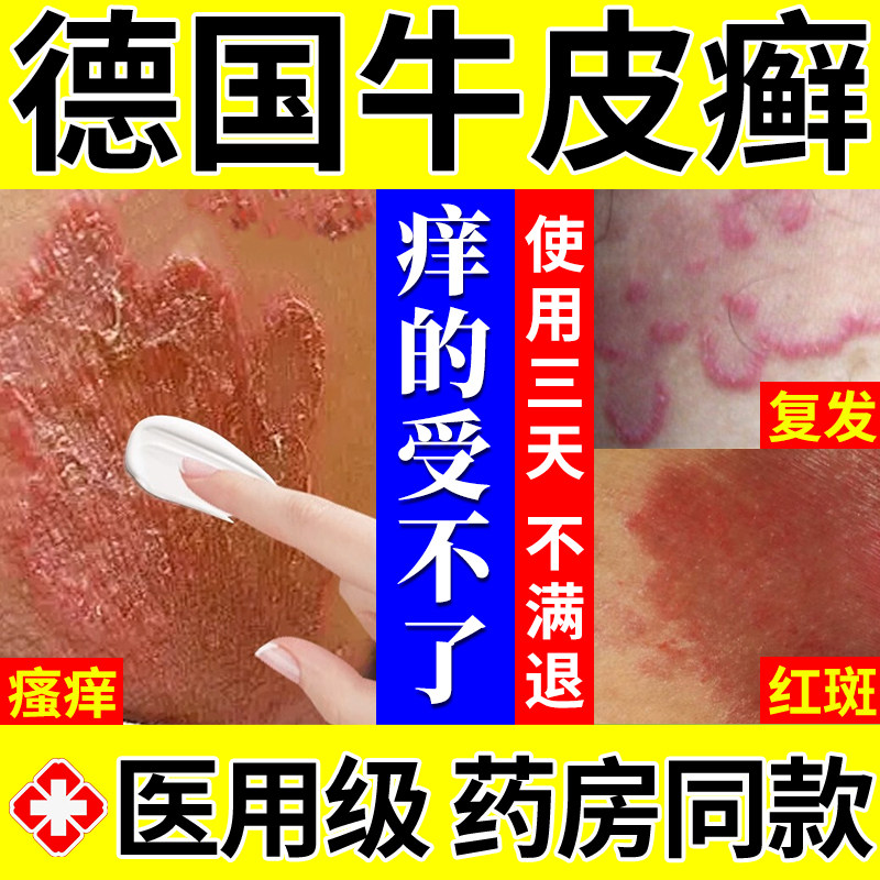 牛皮癣进口银屑病牛皮藓专门用膏真菌感染皮肤病湿疹去止痒根oa