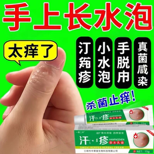 手上起小水泡汗疱泡疹止痒中药抑菌鹅掌风真菌感染手气湿痒专用膏