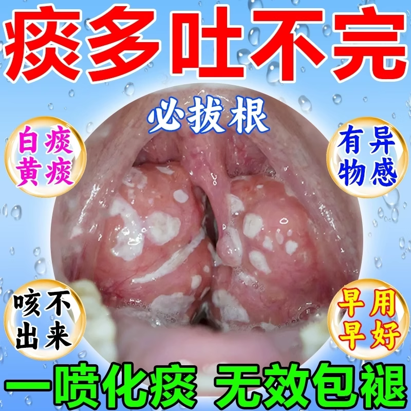 痰多吐不完粘嗓子不舒服老有痰喉咙卡痰异物感干痒肿痛化痰喷雾剂