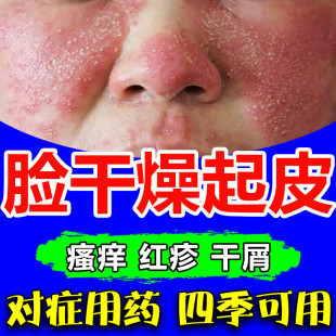 脂溢性皮炎面部软膏脸干燥起皮面部皮炎皮肤过敏专用药修复脸红痒