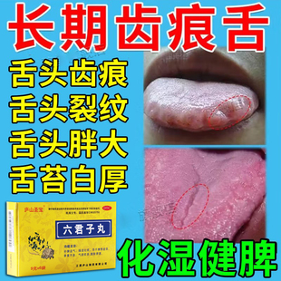 舌苔白厚舌头裂纹有齿痕脾胃虚弱湿气重六君子丸痰湿体质中成药