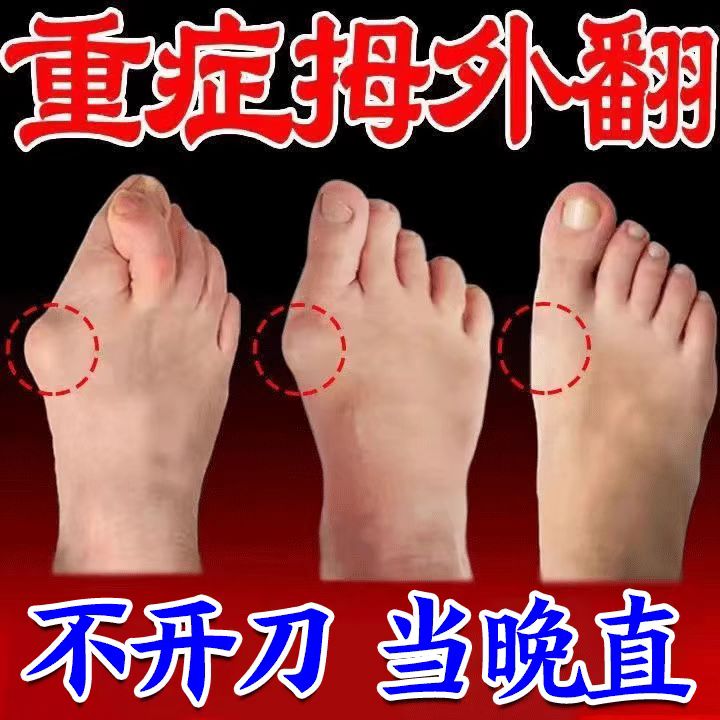 极速拇外a翻神器【矫正】拇指外翻矫正器大脚骨脚趾重叠膏贴MC