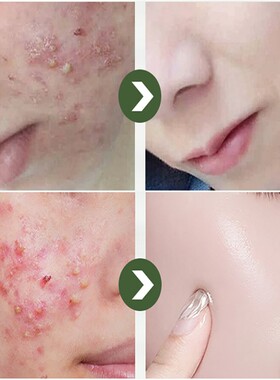 极速Effective Ackne Removal Serum Salicylic Acid Anti-Acne F