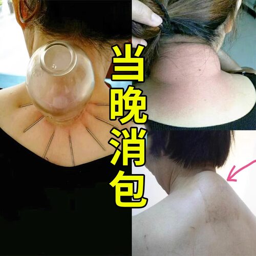 极速【十万人验证过】解决各种颈椎D问题 只要富贵不要包 富贵包