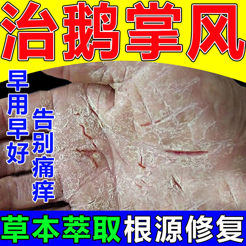 现货速发鹅掌风膏手足癣手气手足藓治干裂手裂药膏脱皮止痒膏