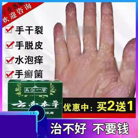 治手干裂蜕皮手掌开裂水泡手气反复膏手脚起皮干燥爆皮药草本抑菌
