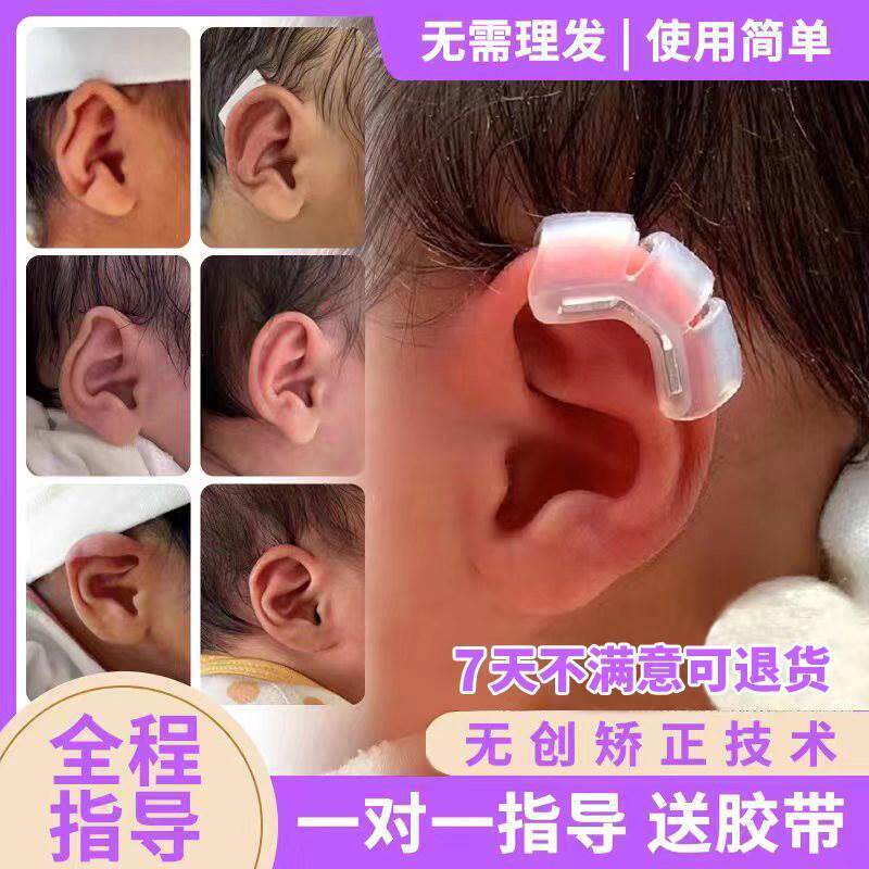 耳朵矫正器婴儿新生的儿耳贴硅胶外耳垂耳招风耳耳夹辅助定型器材