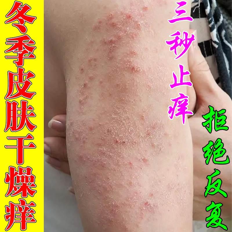 身上皮肤痒秋冬季后背手臂大腿干痒起红疙瘩长小红点抑菌止痒软膏