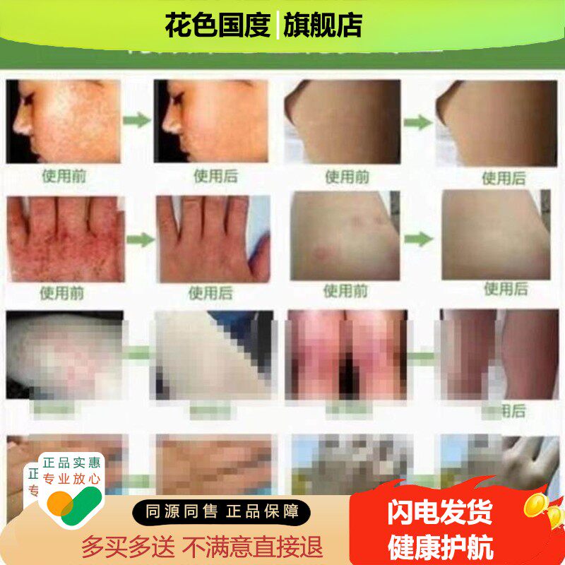 狼毒皮肤止痒抑菌百草软膏药膏正品官方旗舰店止痒过敏乳膏