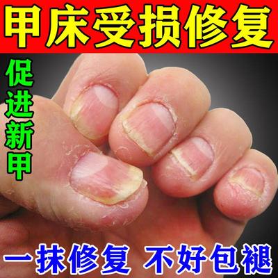 甲床修复生长液啃咬指甲受损萎缩再生甲床分离空甲断甲修复护甲油