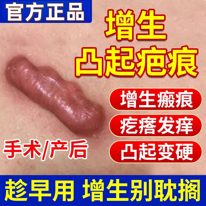 防增生疤痕贴疤痕增生凸起去除疙瘩止痒去疤恢复贴缝针术后TU