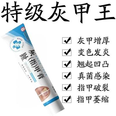 灰指甲药膏去除手趾甲厚甲沟炎