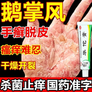 华佗膏治疗鹅掌风专用药手癣膏脱皮干裂真菌感染手掌粗糙变厚药膏
