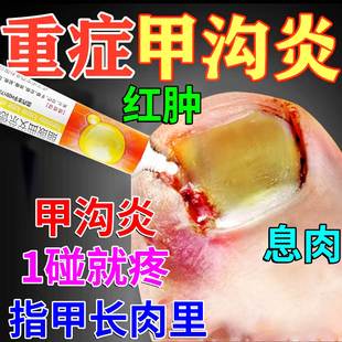 甲沟炎治疗专用药脚趾甲往肉里长指甲消肿去肉芽息肉消肿脚趾