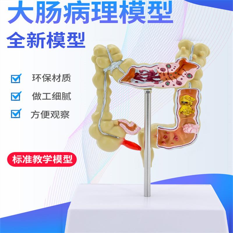 大肠病理模型 小号大肠模型 大肠病变模型 肠道疾病 结肠病变模型