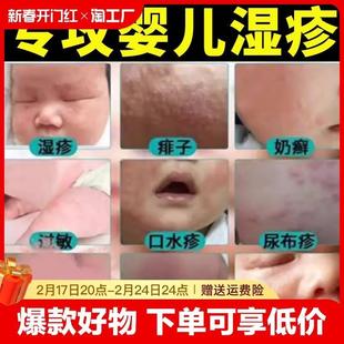 湿疹膏婴儿专用儿童宝宝湿疹口水疹无激素干性保湿 秋冬面霜身体乳