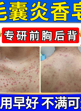 硫磺皂毛囊炎香皂马拉色菌药背上后背长痘痘除螨祛痘痒疼沐浴露TT