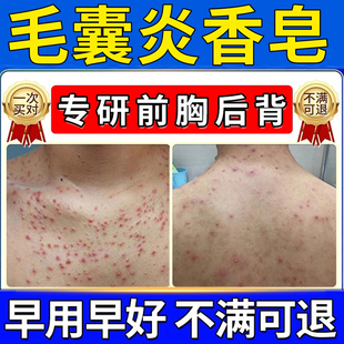 硫磺皂毛囊炎香皂马拉色菌药背上后背长痘痘除螨祛痘痒疼沐浴露TT
