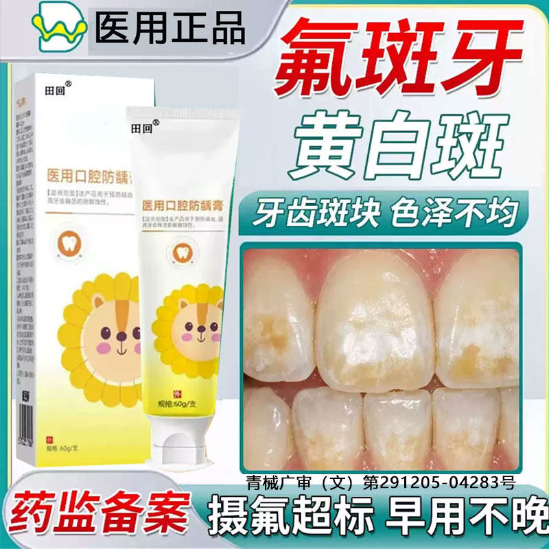 氟斑牙专用可搭牙膏去除变白神器牙齿黑斑去除牙菌斑神器黄黑渍TT