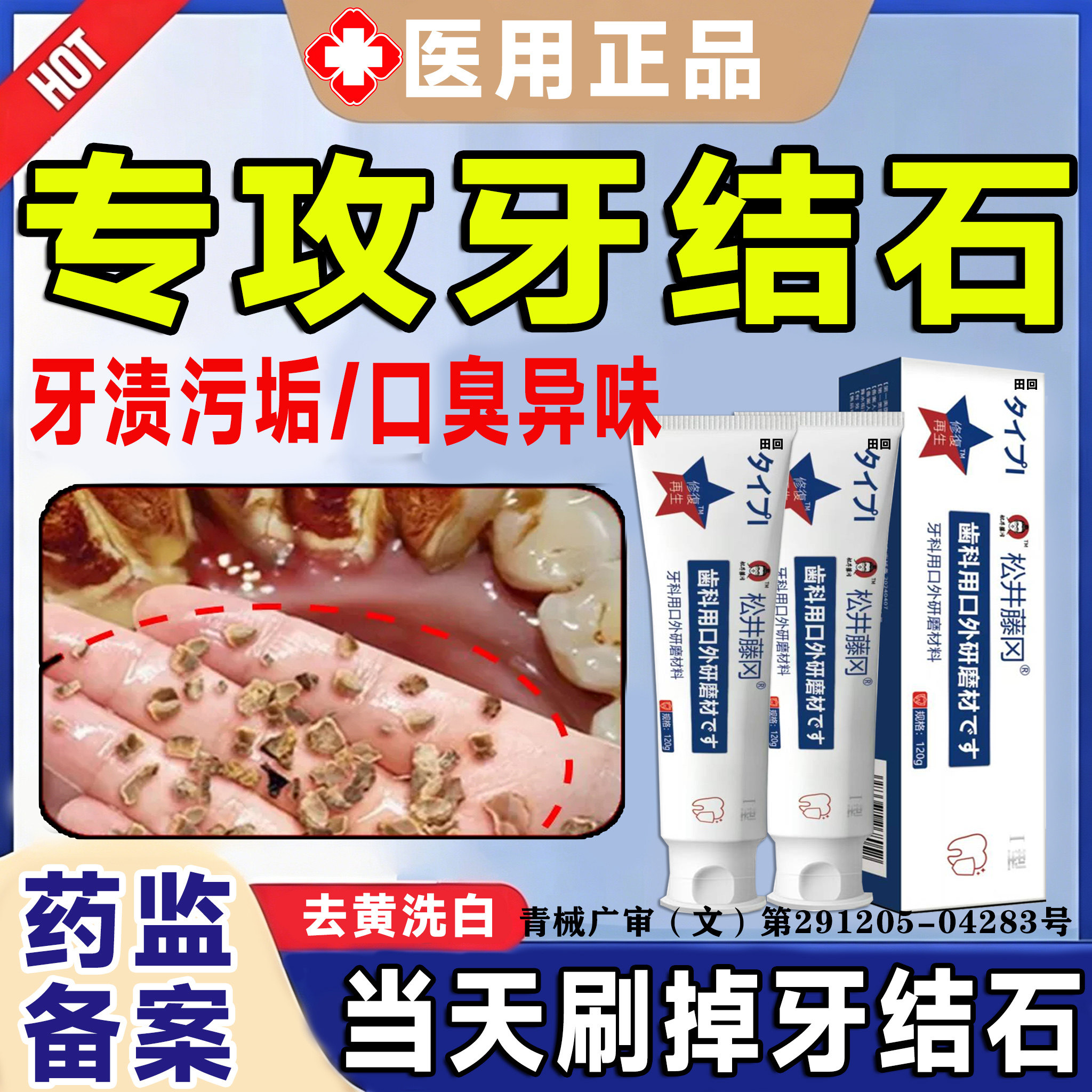 牙结石去除牙膏溶解祛牙石专用重度去黄去口臭美白去烟渍清神器LT