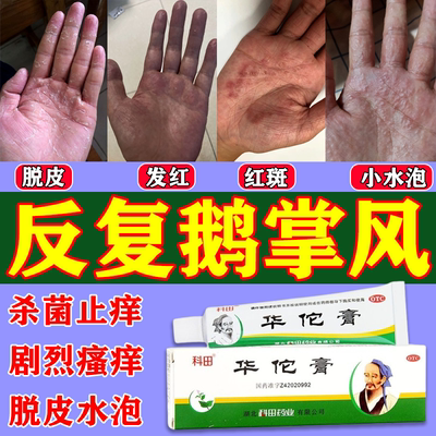 华佗膏治疗鹅掌风专用药手足癣蜕皮干裂真菌感染杀菌止痒正品药膏