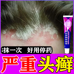 硝酸咪康唑乳膏正品头癣药膏治头皮癣头部红斑瘙痒真菌感染结痂屑