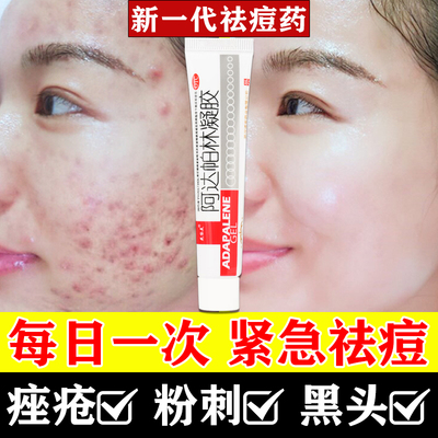 阿达帕林凝胶正品医用官方旗舰店青少年祛痘痘药膏软膏去黑头痤疮