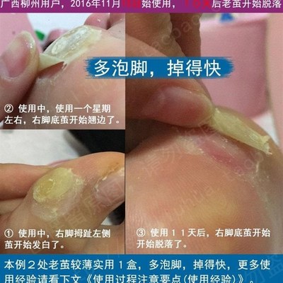消茧灵足部去老茧立洁茧立清结脚上泡脚粉脱死皮脚皮脱皮鸡眼药水