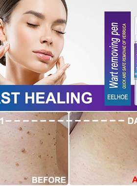 Warts Remover Liquid Antibacterial Ointment Wart Treatment C