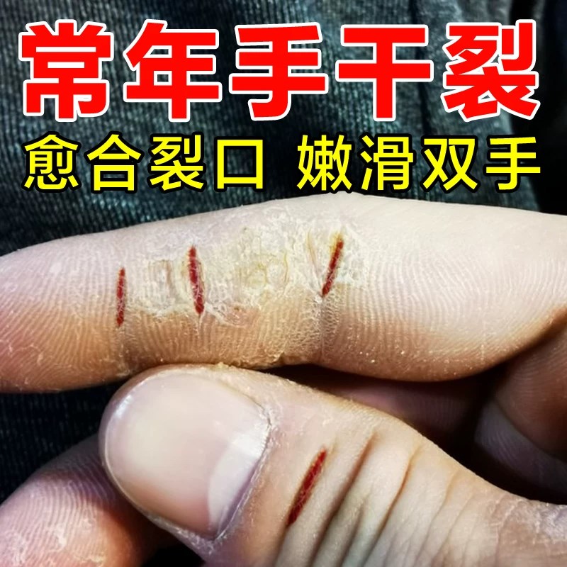 专治手裂口起皮脚裂脚后跟干裂手足修护霜预防冻疮手裂纹皲裂膏LM