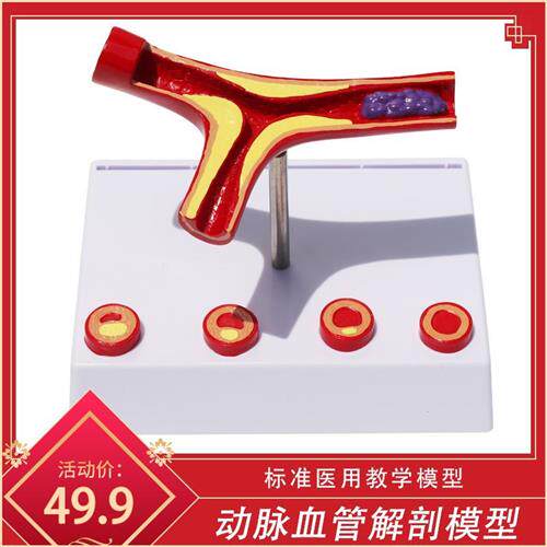 血管/堵塞动支脉粥样/硬化心血管动脉/硬化模型血管病理模型血