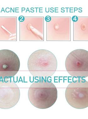 108pcs Warts Remover Patch Skin Tag Remover Wart Treatment