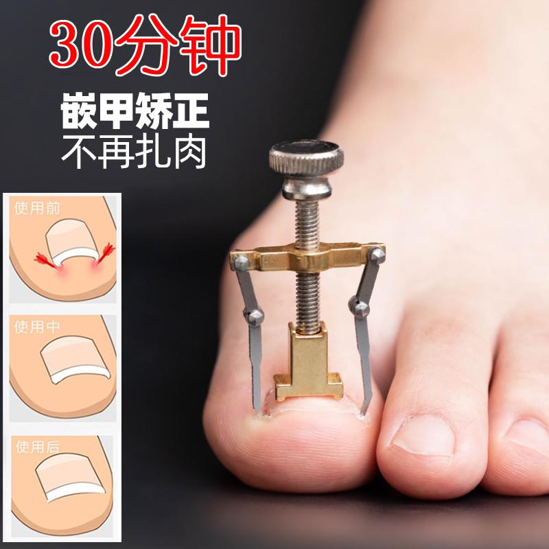 大脚趾指甲矫正器卷扎肉嵌