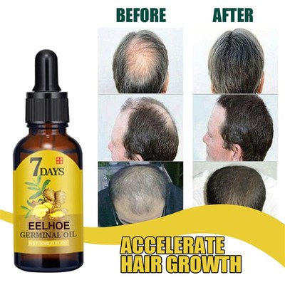 Hair Growth Serum Oil 10/20/40ml Dense Regrowth Ginger Hair