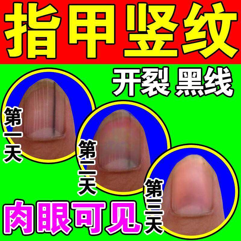 极速指甲竖条纹修复液受损再生黑线凹凸不平甲肉分离甲牀增长营养