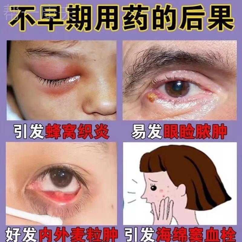 霰粒肿热敷眼膜睑板腺疏通神器堵塞泪道堵塞眼水干眼眼痒麦粒肿